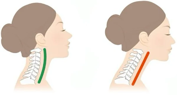 Curva cervical natural comparada con una cervical rectificada