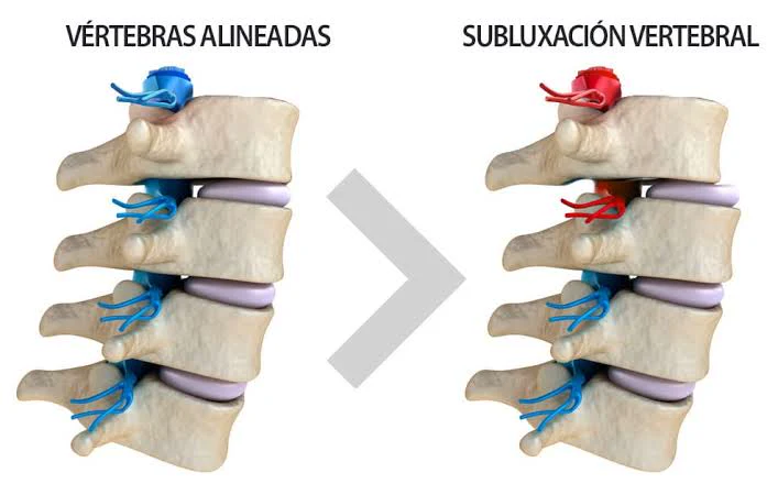 Vértebras alineadas comparadas con una subluxación vertebral